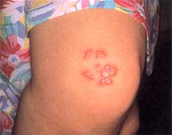 Herpes simplex เริม