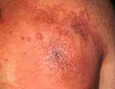 ผื่นแพ้ contact dermatitis