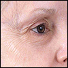 Before botox