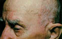 Seborrheic dermatitis