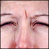 Before botox