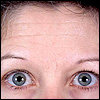 Before botox