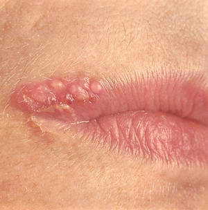 24-Hour Angular Cheilitis Treatment » Get the Home Cure Today