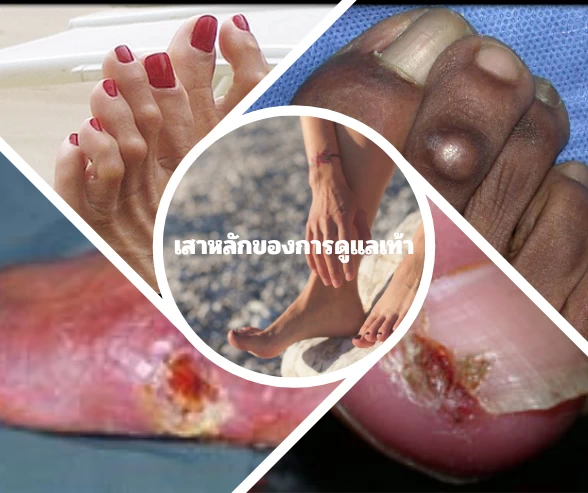 คู่มือป้องกันการตัดขาสำหรับผู้ป่วยเบาหวาน