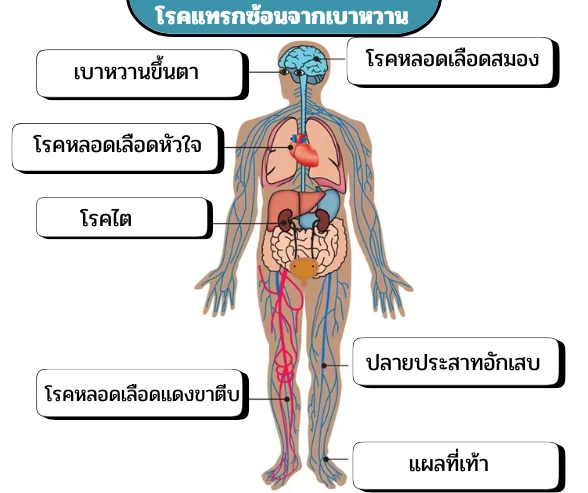 โรคแทรกซ้อนจากเบาหวาน
