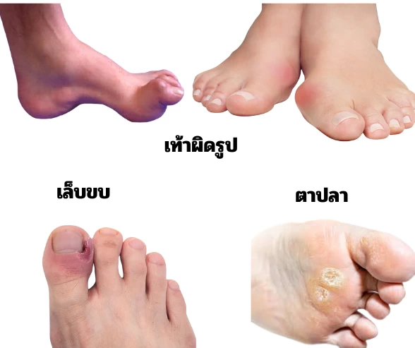รูปร่างเท้าผิดปกติ