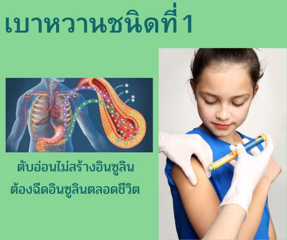 เบาหวานชนิดที่1