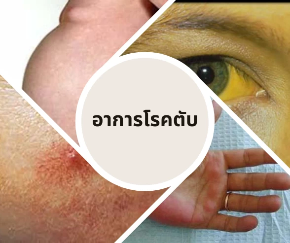 อาการของโรคตับ