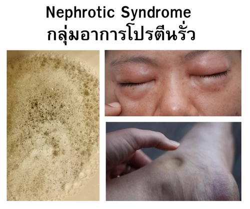 โปรตีนในปัสสาวะ