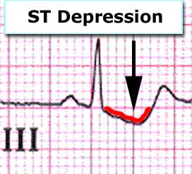 ecg กล้ามเนื้อหัวใจขาดเลือด