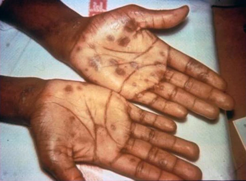 ผื่นที่ผ่ามือ