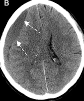 subdural