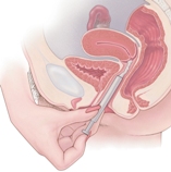 การใช้ยาฆ่า Sperm
