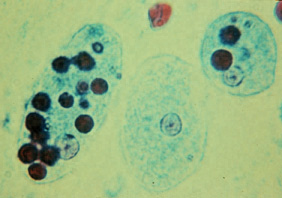 E. histolytica trophozoite with ingested erythrocytes