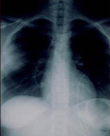 Aspergillosis - chest X-ray