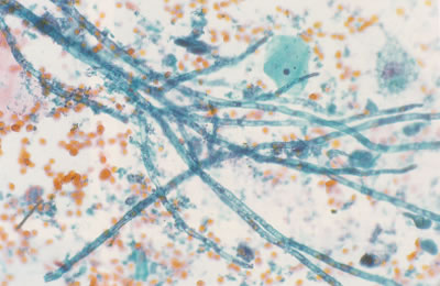 การติดเชื้อราAspergillosis