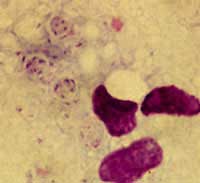 เชื้อPneumocystis carinii