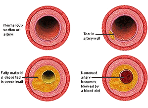 ไขมันอุดหลอดเลือดแดง