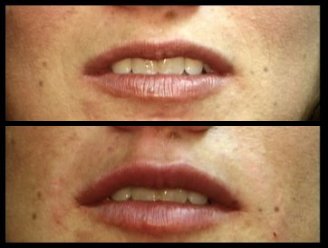 Collagen-lips-AP.jpg (15159 bytes)