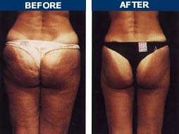 Endermologie Before & After Photo 1