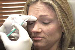 Botox treatment