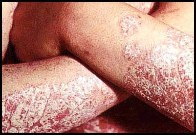 สะเก็ดเงิน