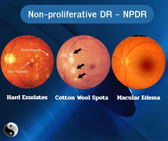 เบาหวานขึ้นตา NPDR