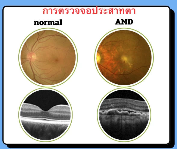 การตรวจภาพจอประสาทตา