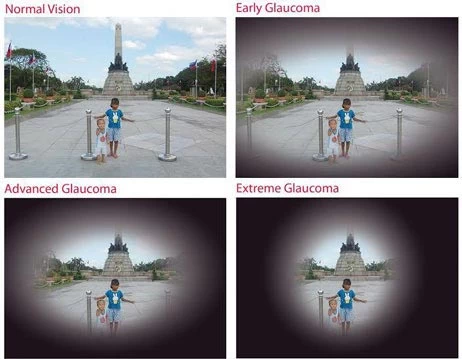 ภาพที่คนเป็นต้อหินมองเห็น