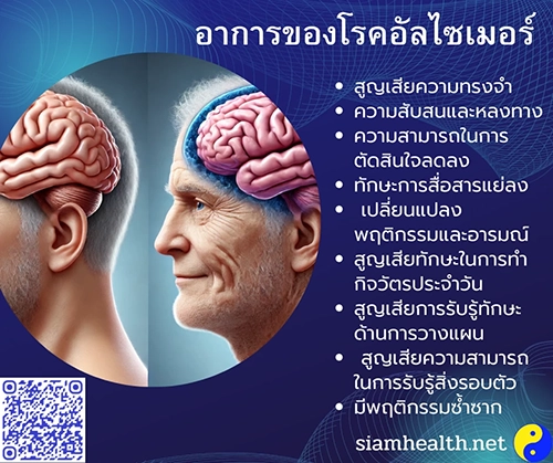 อาการอัลไซม์เมอร์