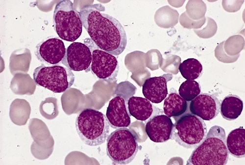 lymphoblast