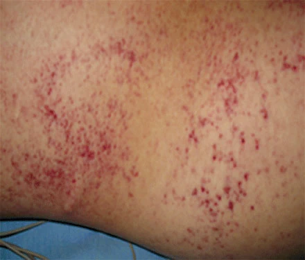 อาการไข้เลือดออกมีจุดเลือดออก