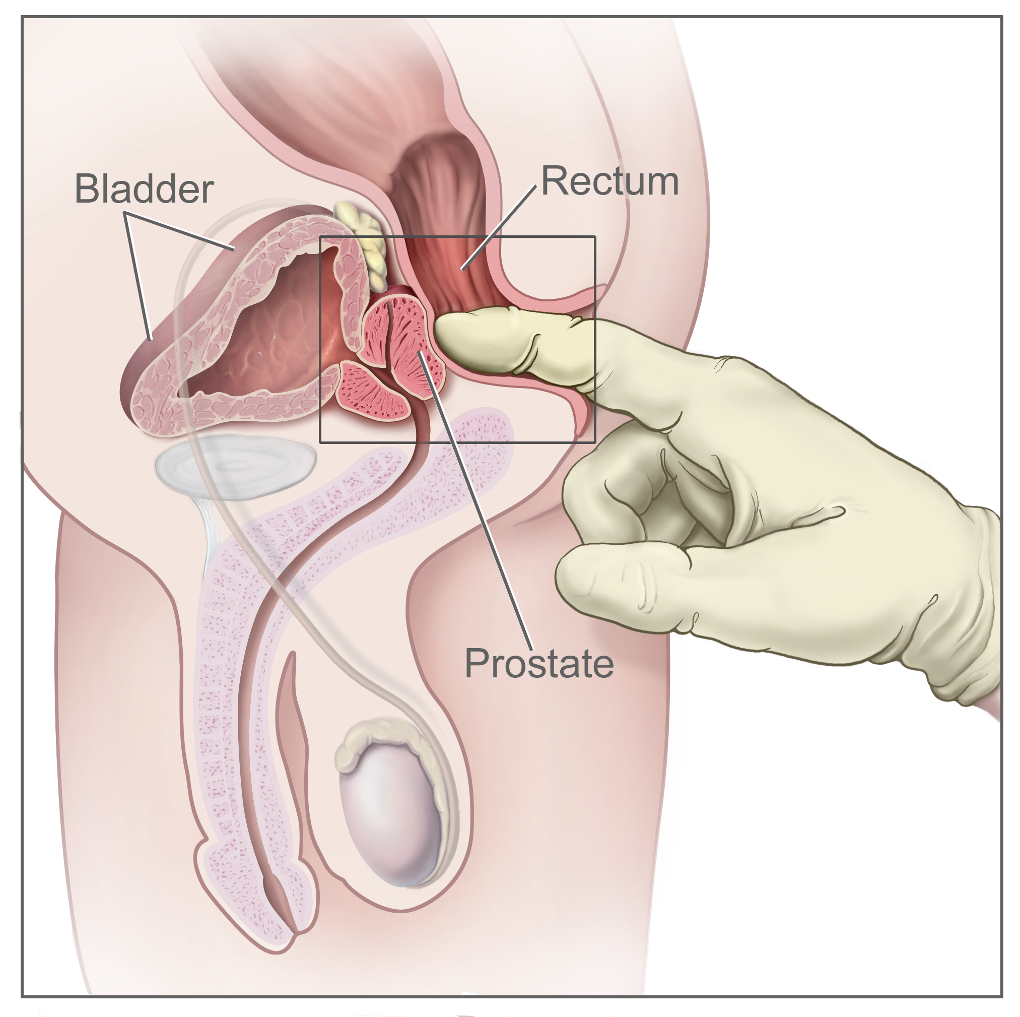 prostata túltengés ii stádium)