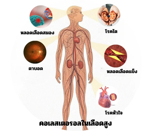 คอเลสเตอรอลทำให้เกิดโรคอะไร