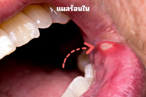 แผลร้อนใน