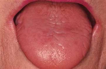 ปากแห้ง