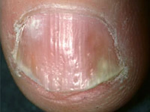 สะเก็ดเงินที่เล็บ