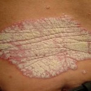 สะเก็ดเงิน