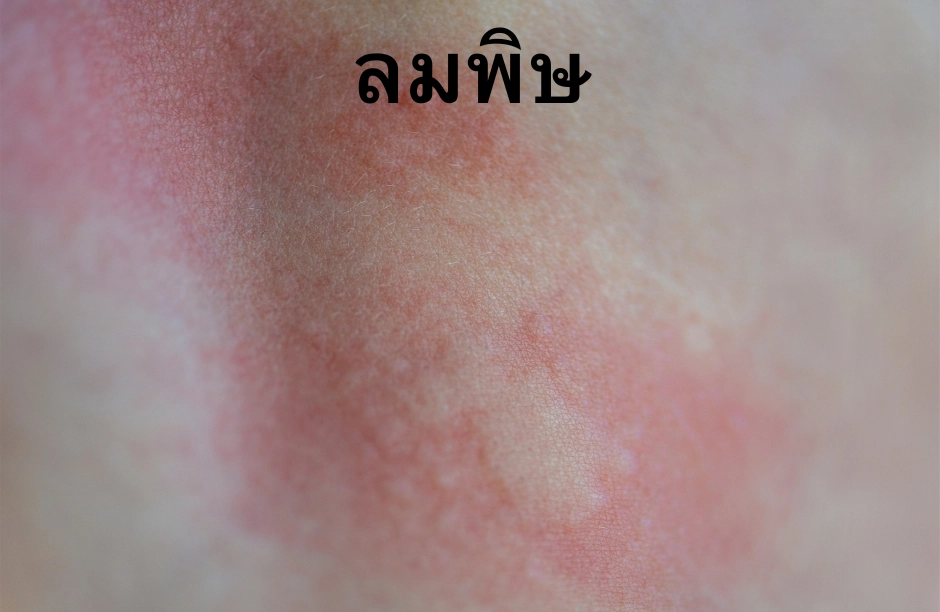ลมพิษ