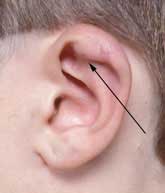 Upper ear infection